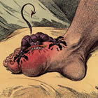 Enfermedad gota: dedo gordo del pie